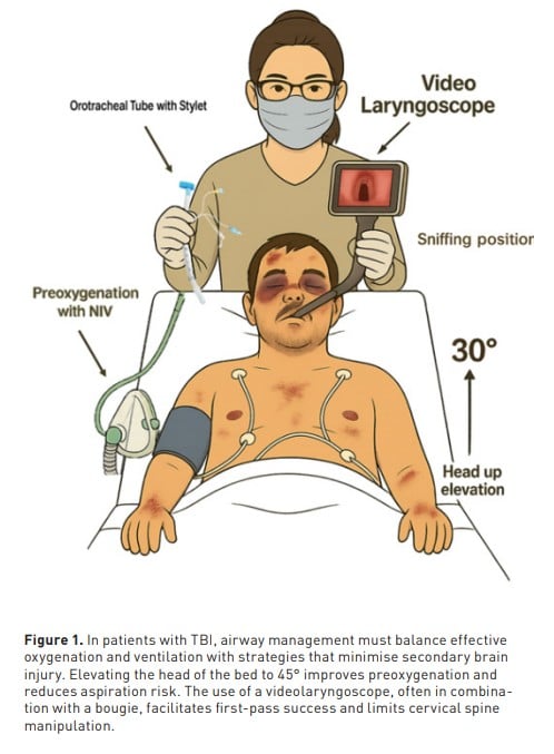 [ICU Management & Practice]: 急性颅脑创伤患者的气道管理