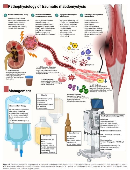 [ICU Management & Practice]: 重症患者的创伤性横纹肌溶解：当前概念与临床策略