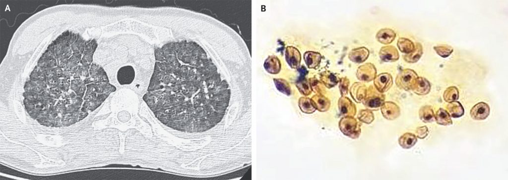 [NEJM临床医学影像]：耶氏肺孢子虫肺炎