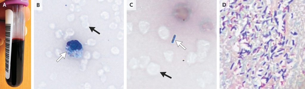 [NEJM临床医学影像]：产气荚膜杆菌菌血症导致的大量血管内溶血